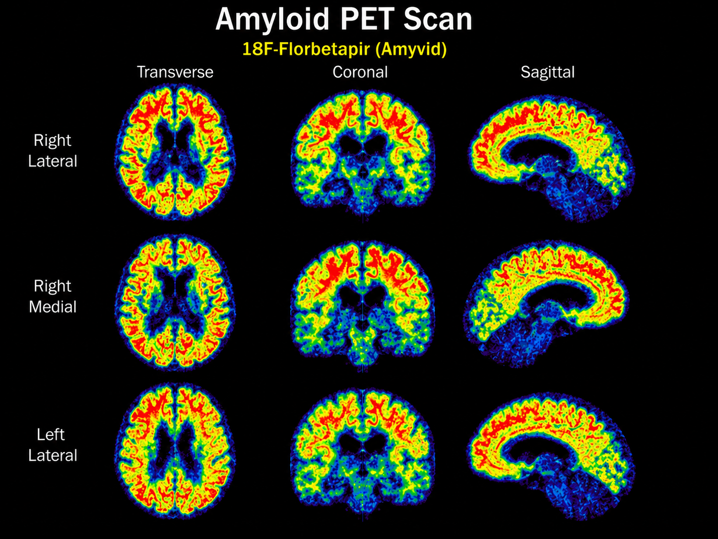 Amyloid PET scan using 18F-Florbetapir (Amyvid), showing transverse, coronal and sagittal brain views in which amyloid plaque burden is measured